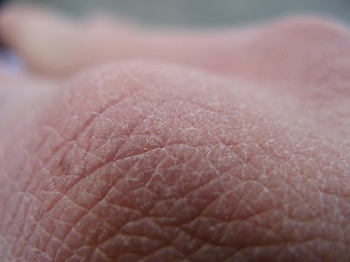 mindre vanliga symptom på diabetes är torr hud