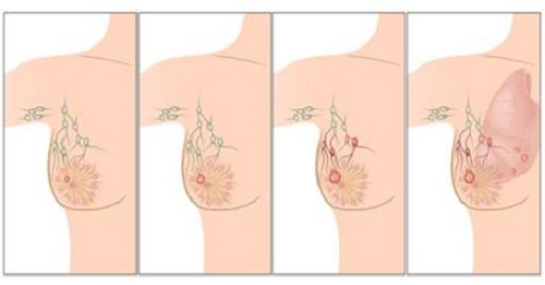 Stadier av bröstcancer