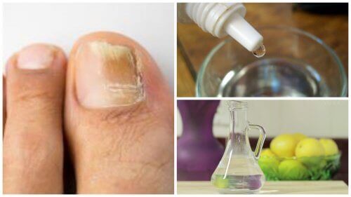 Behandla nagelsvamp naturligt med 3 ingredienser