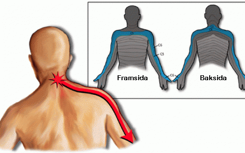 cervikobrakialt syndrom