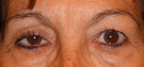 Förlusten av näringsämnen i huden gör att du får hängande ögonlock