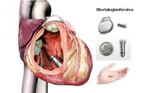 pacemaker