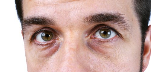 Mörka ringar under ögonen - 4 naturliga lösningar
