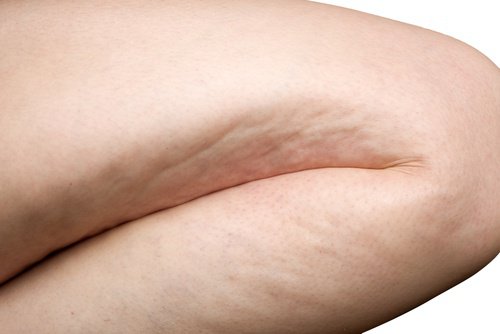 hur får man bort celluliter på benen