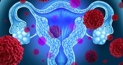 Toxiskt chocksyndrom och tamponger: Var försiktig!