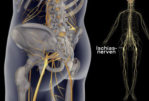 Rekommendationer för att lindra smärta i ischiasnerven