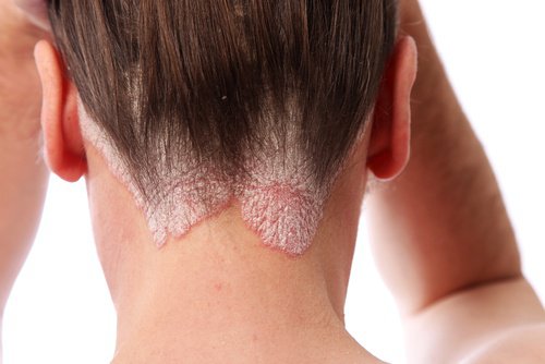 Psoriasis kan även drabba öron, ansikte och skalp
