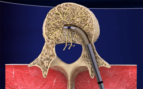 Intracept: Ny behandling för smärta i ländryggen