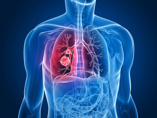 kropp med lungcancer