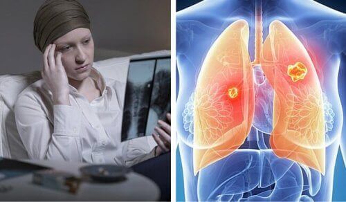 Lungcancer hos kvinnor är mycket dödligare