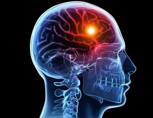 8 varningstecken på cerebral stroke