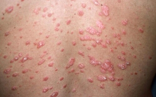 Olika typer av psoriasis och symptom