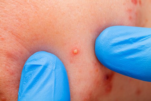 Gifter i kroppen kan orsaka akne