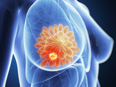 Ny metod för att ta bort bröstcancertumörer på 11 dagar