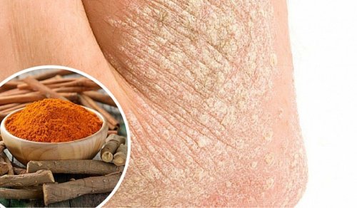 7 naturliga sätt att bekämpa psoriasis