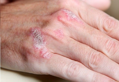 5 saker du borde veta om autoimmuna sjukdomar