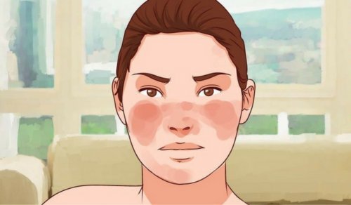 7 effektiva kurer för att kontrollera lupus