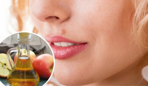 Ta bort leverfläckar naturligt med dessa huskurer