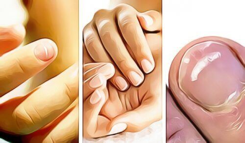 5 sätt dina fingernaglar signalerar hälsoproblem
