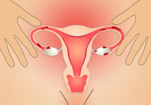 5 sätt att förbättra livet om du lider av endometrios