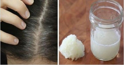 Lök- och honungskur för att förebygga håravfall