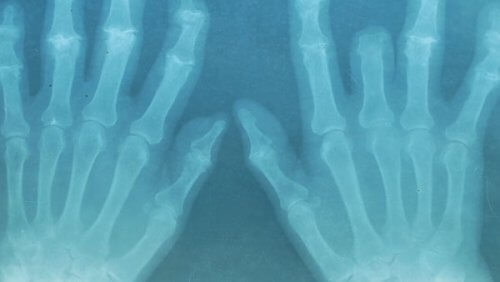 Händer i röntgen