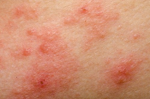 Nio naturliga huskurer för rosacea
