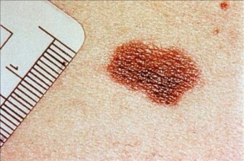 Tecken på hudcancer du inte borde ignorera