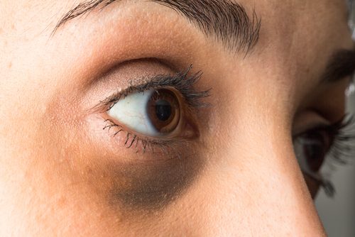 Hormonell obalans kan ge mörka påsar under ögonen