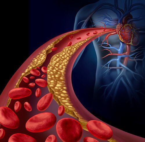 Arteriell ateroskleros