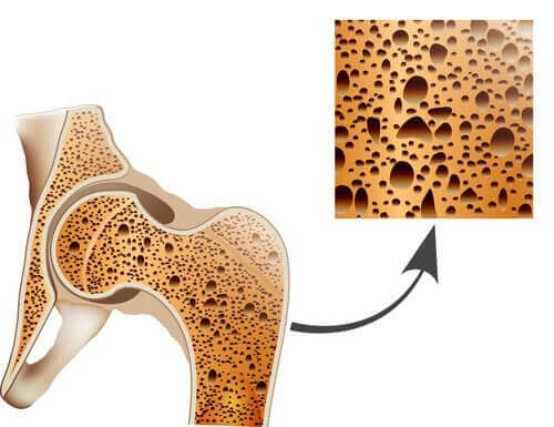 Osteoporos urholkar benen