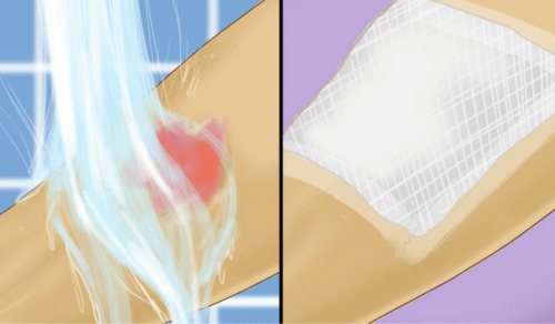 Första hjälpen för brännskador av hett vatten