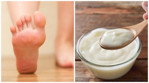 Yoghurt och vinäger kan ta bort valkar på fötterna