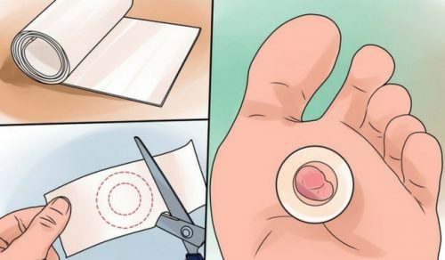 9 effektiva kurer för att läka blåsor