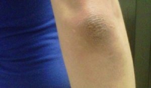 Blek armbågar och knän med en hemgjord hudkräm
