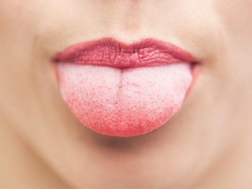 Ljus tunga kan vara ett tecken på en svampinfektion