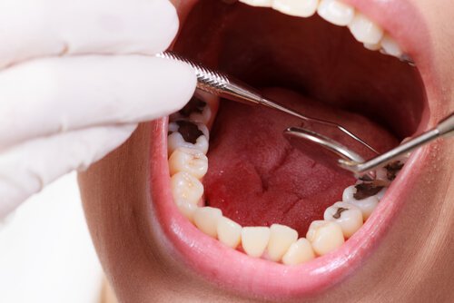 Tranbärsjuice förebygger hål i tänderna
