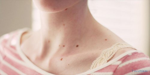 Dessa örter kan hjälpa dig att förebygga hudcancer