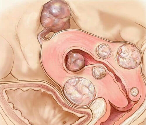 Myom på livmodern