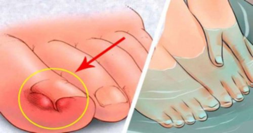 6 effektiva huskurer mot nageltrång