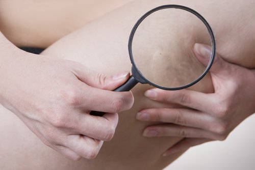 Celluliter på låret