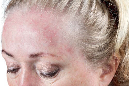 Att ha fuktigt hår när du sover ökar risken för hudinfektioner