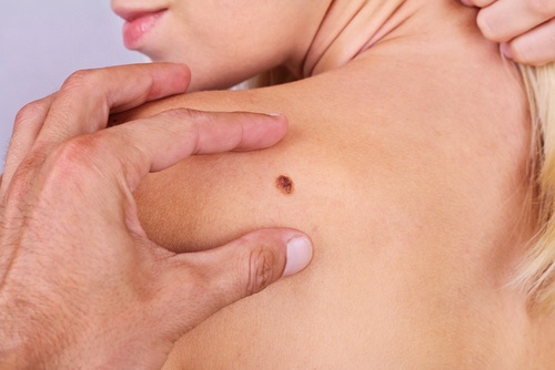 6 symptom på hudcancer du inte borde ignorera