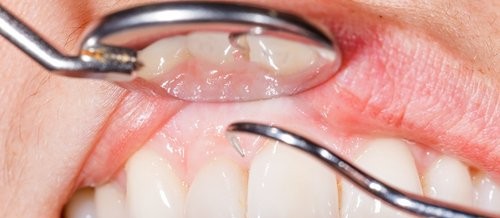 14 anledningar till varför ditt tandkött blöder