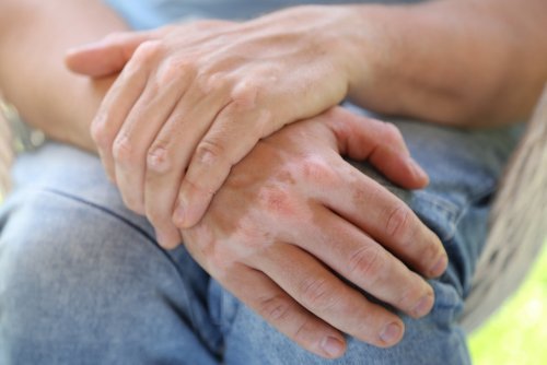 9 naturliga och effektiva kurer för vitiligo