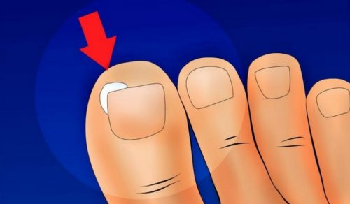 hur behandlar man nageltrång