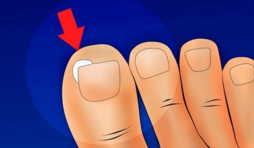 Hur man förebygger nageltrång: enkla tips