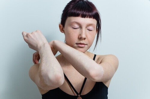 Vitiligo på armarna