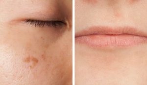 5 sätt ditt ansikte kan varna dig om vitaminbrist