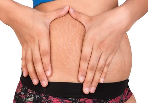 Två naturliga alternativ för att behandla hudbristningar